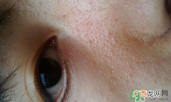 眼霜可以去除脂肪粒吗?眼霜可以消除脂肪粒吗?