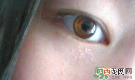 眼霜可以去除脂肪粒吗?眼霜可以消除脂肪粒吗?