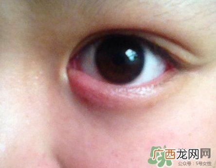 眼睛下面长痘痘是什么原因?眼睛下面长痘痘怎么办?