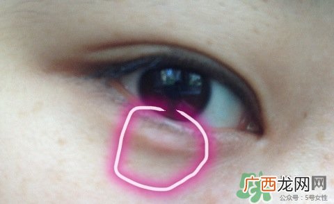 眼睛下面长痘痘是什么原因?眼睛下面长痘痘怎么办?