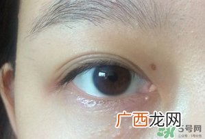 眼睛下面长痘痘是什么原因?眼睛下面长痘痘怎么办?