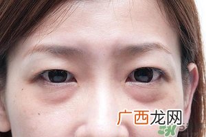 眼睛下面肿得像眼袋是怎么回事?怎么办?