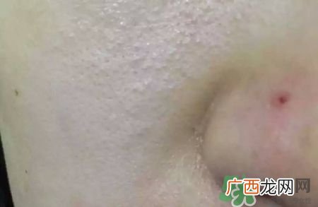 闭合性粉刺怎么消除?闭合性粉刺怎么根除?