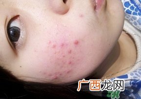 闭合性粉刺能自愈吗?闭合性粉刺可以自愈吗?