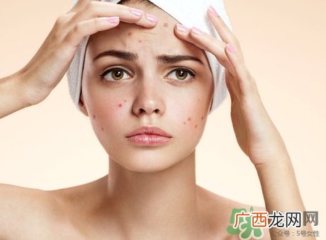 闭合性粉刺能自愈吗?闭合性粉刺可以自愈吗?