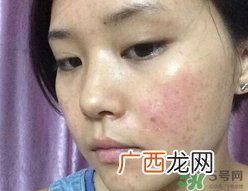 闭合性粉刺用什么药膏?闭合性粉刺怎么治疗?