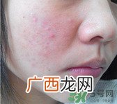 闭合性粉刺用什么药膏?闭合性粉刺怎么治疗?