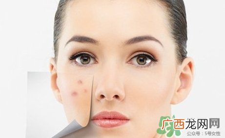 青春痘会自己消失吗?青春痘会不会自己好?
