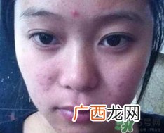 青春痘会自己消失吗?青春痘会不会自己好?