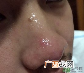 wis去黑头套装多少钱?wis去黑头套装价格