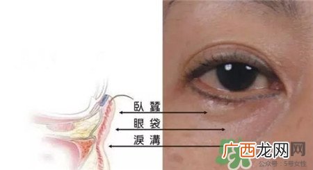 泪沟是怎么形成的?泪沟和眼袋的区别