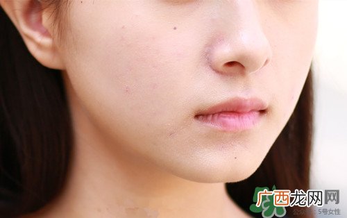 黑色痘印怎么消除小妙招?黑色痘印会自己消失吗