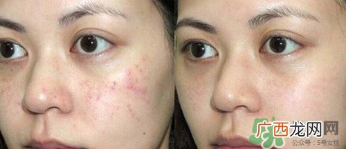 黑色痘印怎么消除小妙招?黑色痘印会自己消失吗