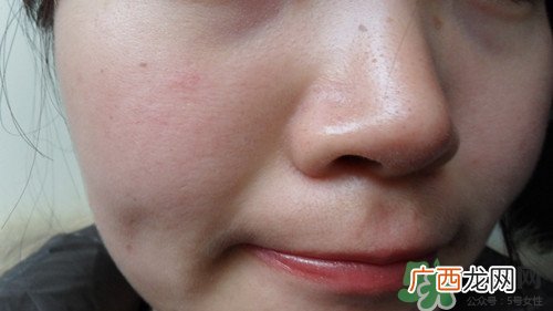 黑色痘印怎么消除小妙招?黑色痘印会自己消失吗