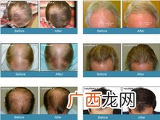 hairmax激光生发梳有用吗?hairmax激光生发梳怎么样?