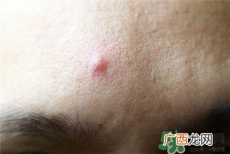 酒刺里面的白色是什么?酒刺里面是什么?