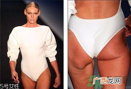 橘皮纹是肥胖纹吗?橘皮纹和肥胖纹的区别