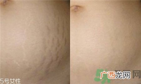 橘皮纹是肥胖纹吗?橘皮纹和肥胖纹的区别