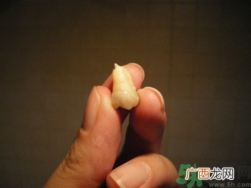 拔智齿能瘦脸吗?拔智齿后注意事项
