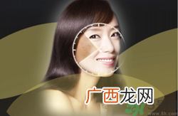 晒斑可以自己消退吗？晒斑可以用激光去除吗？