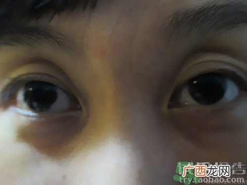 蛇毒眼膜效果怎么样？spa蛇毒眼膜红色好用吗？