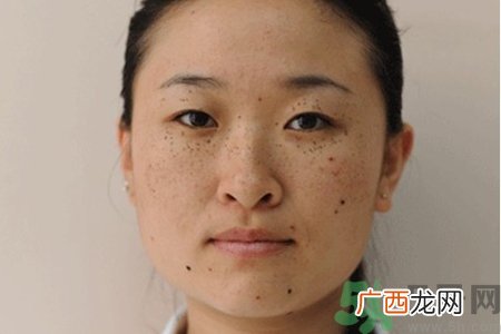 脸上长雀斑吃什么好？有雀斑不能吃什么？