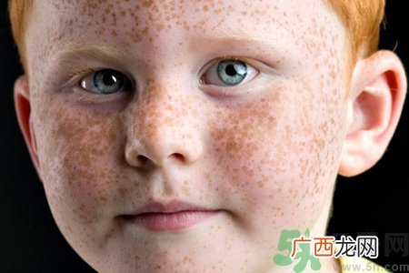 脸上长雀斑吃什么好？有雀斑不能吃什么？