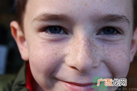 青春期长雀斑怎么办?青春期长雀斑正常吗
