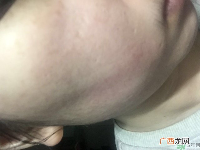 宠爱之名生物纤维面膜用完要洗脸吗?