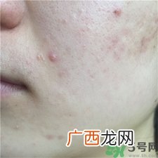 宝拉珍选水杨酸有用吗?宝拉水杨酸怎么样?
