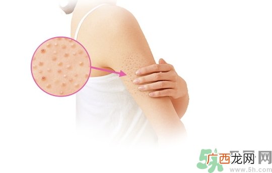 小林制药去鸡皮膏怎么用?小林制药去鸡皮膏使用方法