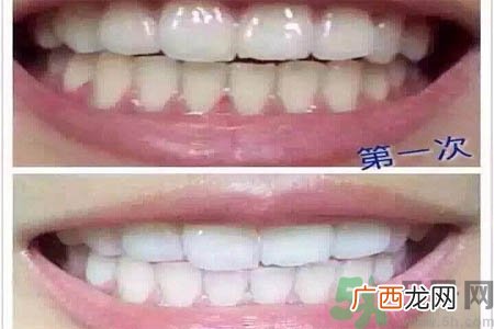 冷光美白牙齿的价格是多少？做冷光美白牙齿需要多少钱？