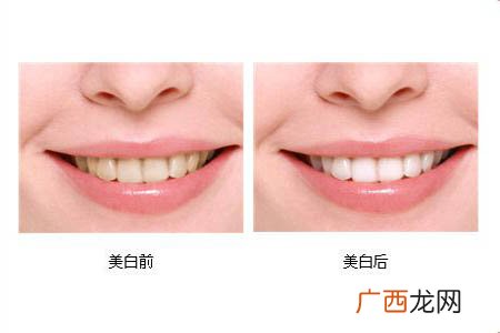冷光美白牙齿可以保持多长时间？冷光美白牙齿有副作用吗？