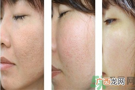皮肤毛孔粗大原因有哪些？如何预防皮肤毛孔粗大？