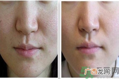 皮肤毛孔粗大原因有哪些？如何预防皮肤毛孔粗大？