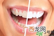 美白牙齿的方法有哪些？美白牙齿有哪些方法？