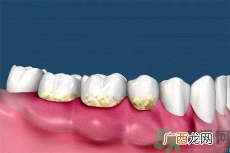 哪些人不能洗牙？洗牙需要注意什么？