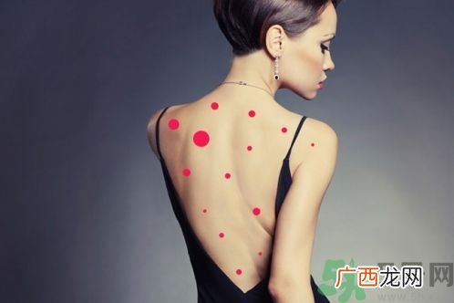 背上为什么会长痘痘?长痘痘怎么办?