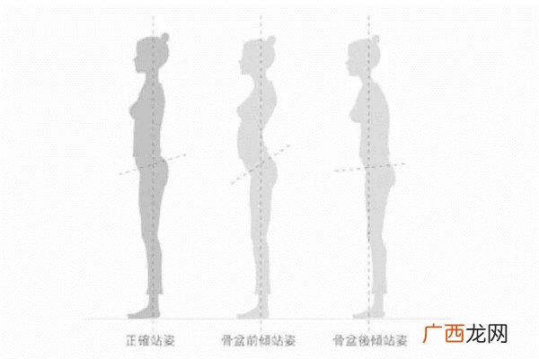 骨盆前倾是天生的吗骨盆前倾是不是容易腰疼