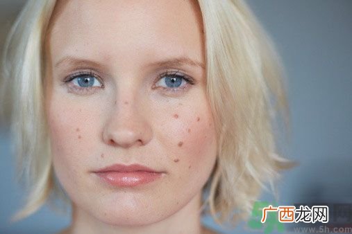 为什么会长痘痘？痘痘有哪几种类型的？