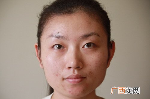 去除痘印的12个小偏方