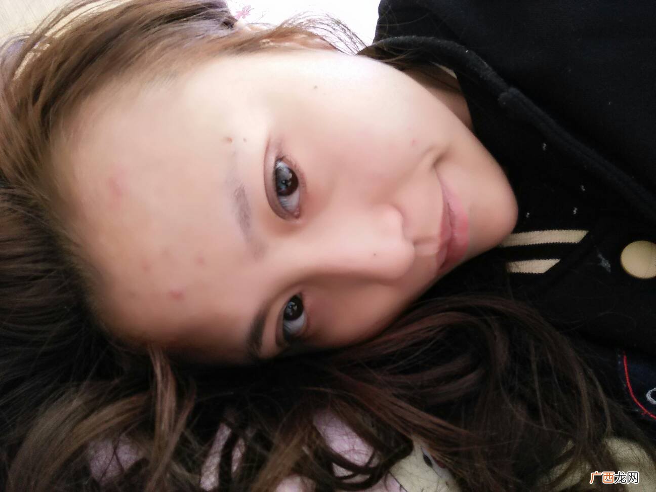 额头上长痘痘是什么原因