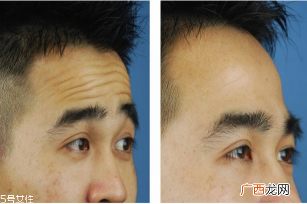 抬头纹怎么去除？小妙招教给你