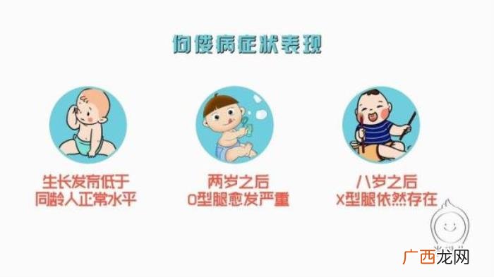 内八字腿型，婴幼儿有O型腿或内八字需要治疗吗