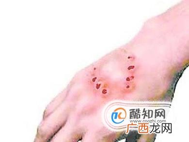 吸毒者初期的症状