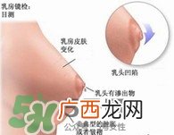乳腺增生怎么根治 得了乳腺增生能根治吗