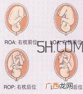 什么情况下需要剖腹产 剖腹产最全科普