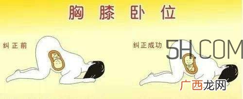 什么情况下需要剖腹产 剖腹产最全科普