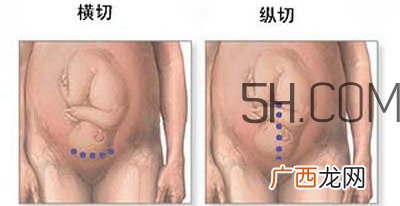 什么情况下需要剖腹产 剖腹产最全科普