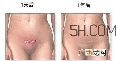 什么情况下需要剖腹产 剖腹产最全科普